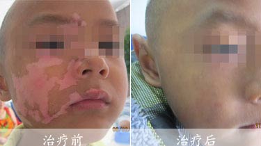 青少年脸上有白癜风是怎么回事